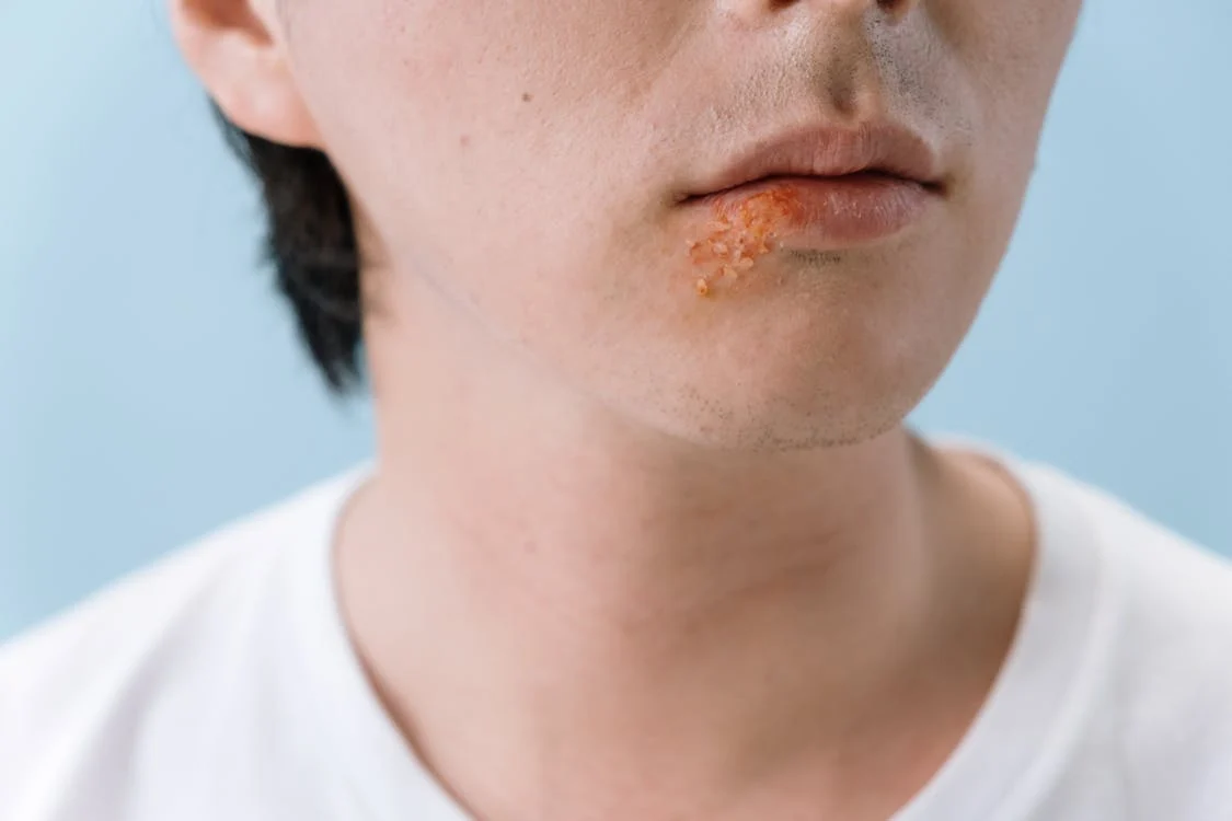 Herpes-aanvallen – Wat te doen?