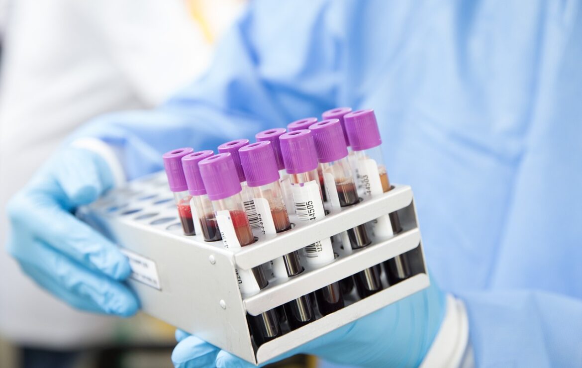 Testosteron Bloedtest